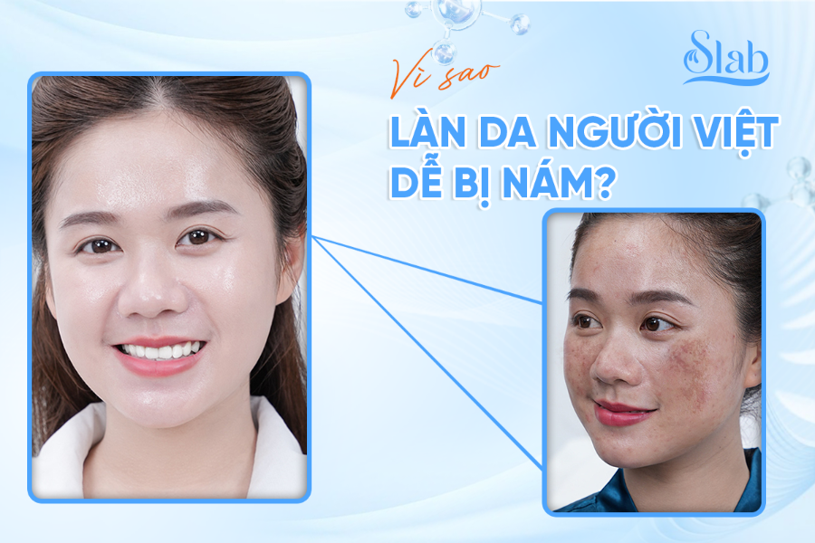 Vì sao làn da người Việt dễ bị nám?