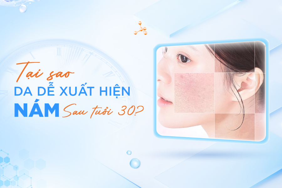 Nám da sau tuổi 30 và nguyên nhân ít ai để ý