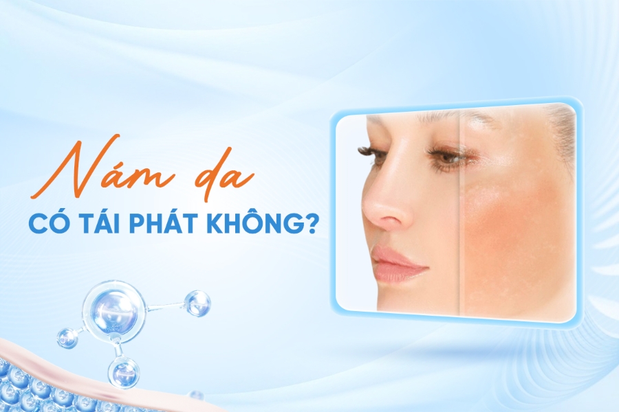 Nám Da Có Tái Phát Không? "Lá Chắn" Kem Chống Nắng Và Cách Bảo Vệ Da Nám Hiệu Quả